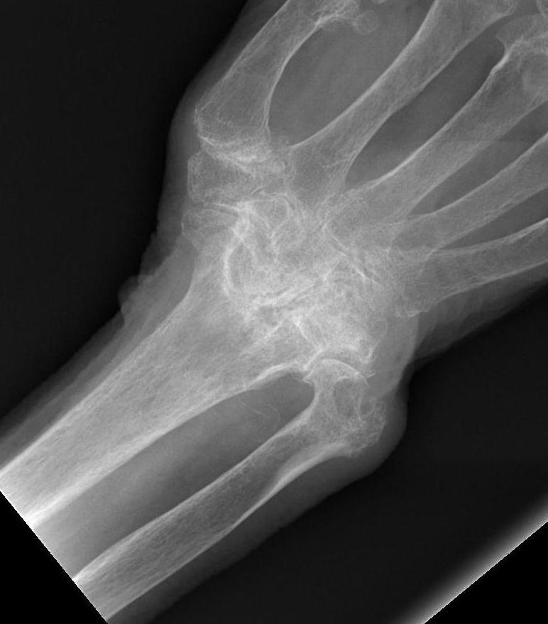 RA wrist