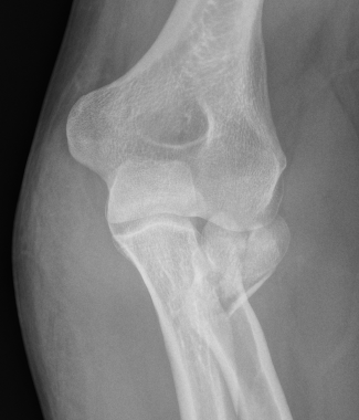 radial neck