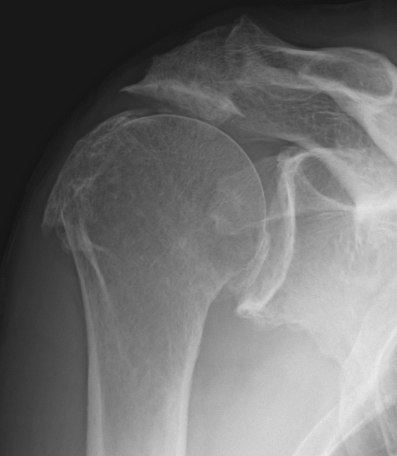RC arthropathy