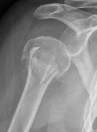 fibular strut