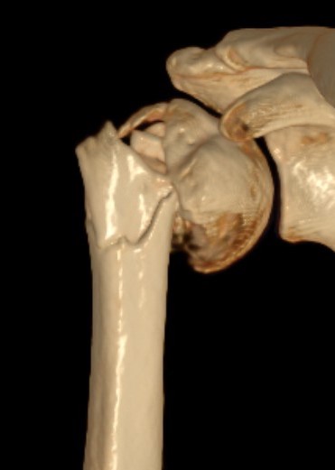 fibular strut