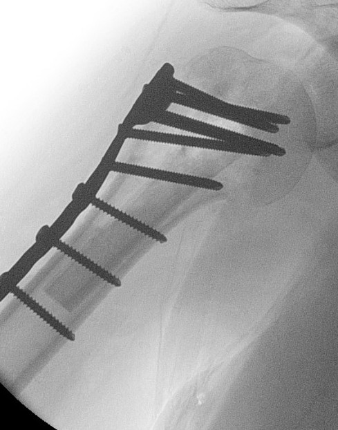 fibular strut