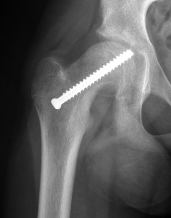 intra articular