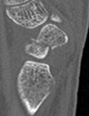 scaphoid