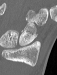 scaphoid
