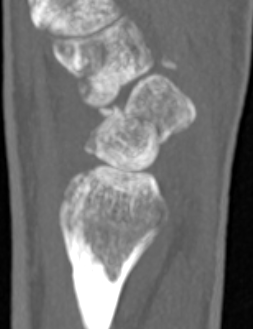 scaphoid