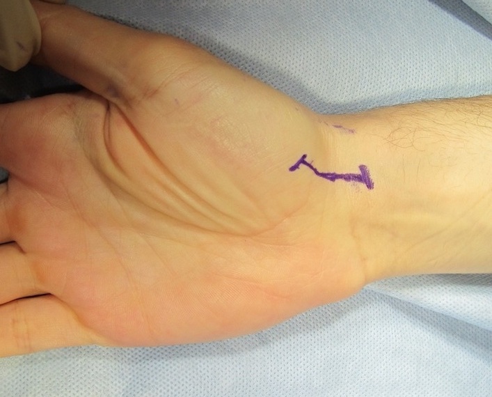 scaphoid ORIF