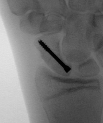 dorsal screw