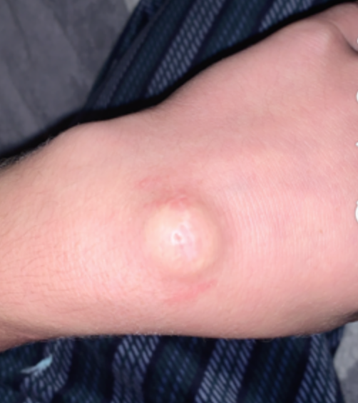 ganglion