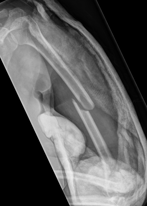 Humerus shaft