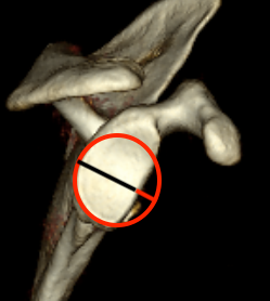 Bony bankart