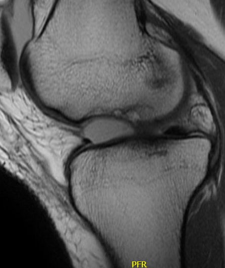 Osteochondral defect