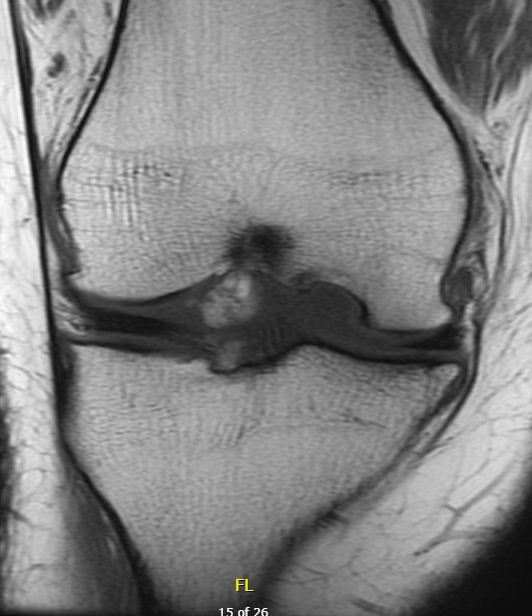 Osteochondral defect