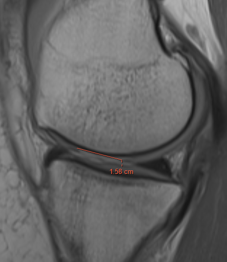 Chondral defect