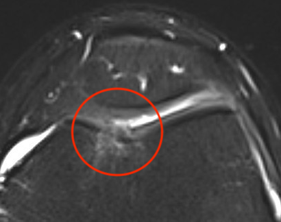 Trochlea MRI