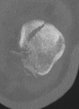 CT PFJ