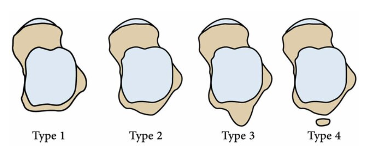 posterolateral tubercle