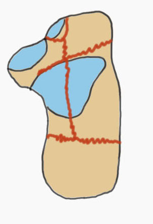 Calc fracture