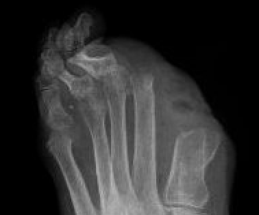 Toe amputation