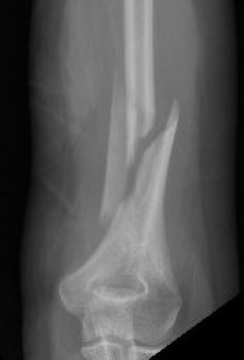 Distal 1/3