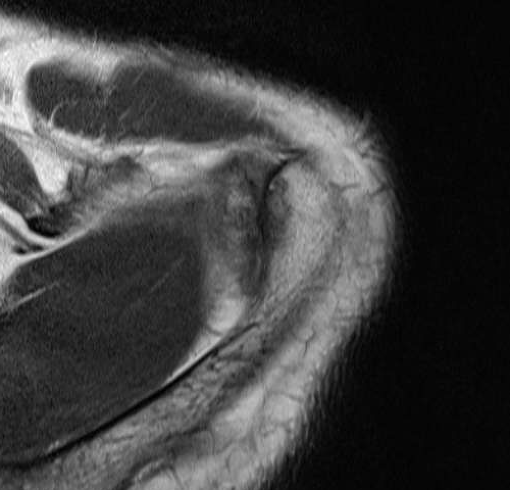 osteolysis