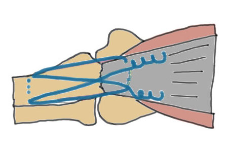 tension suture