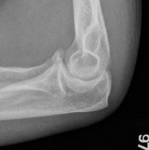 coronoid p