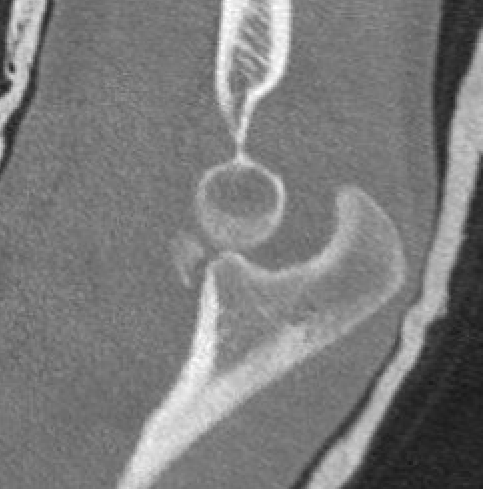 Coronoid p