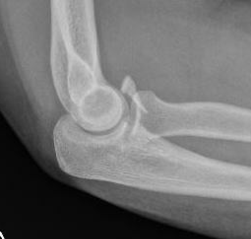 coronoid p