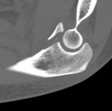 coronoid