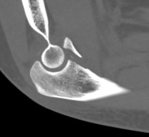 coronoid p