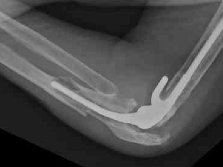 TER fracture