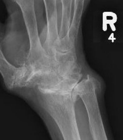 RA
