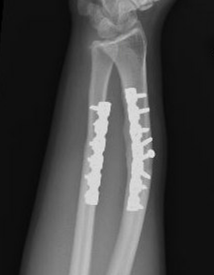 malunion