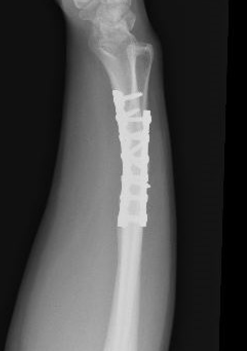 malunion