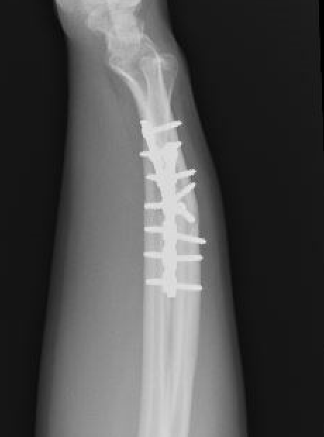 malunion