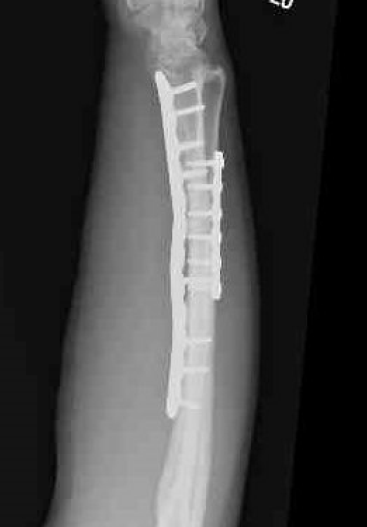 malunion