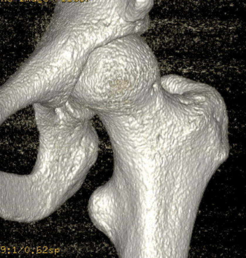 IFI