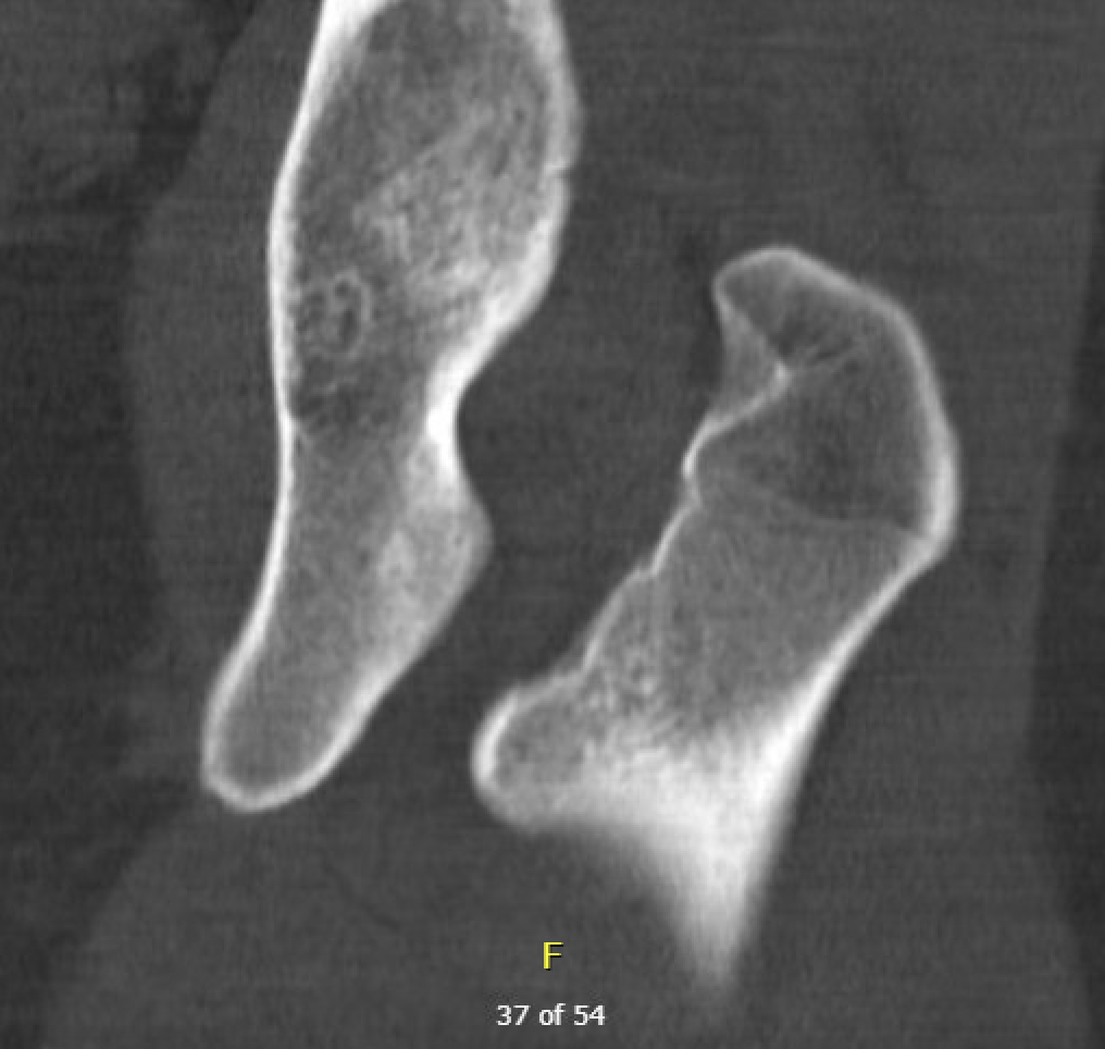 IFI