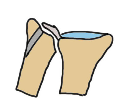 ulna sided repair
