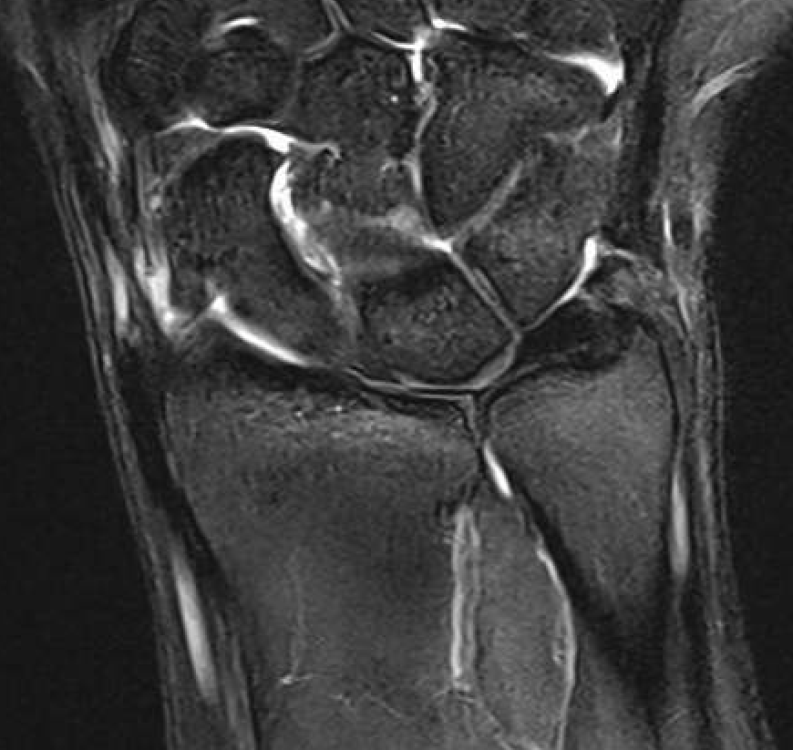 ulna shortening