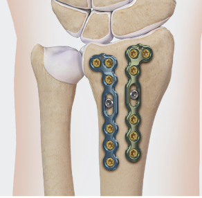 Dorsal L plates