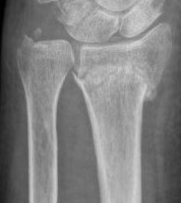 ulna styloid