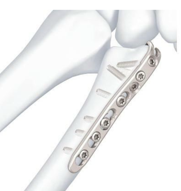 Ulna hook plate