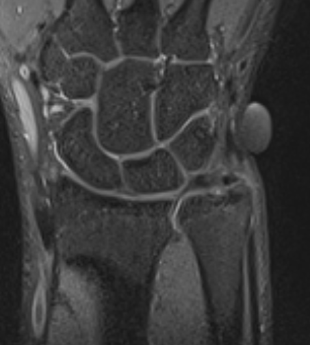 ulna styloid