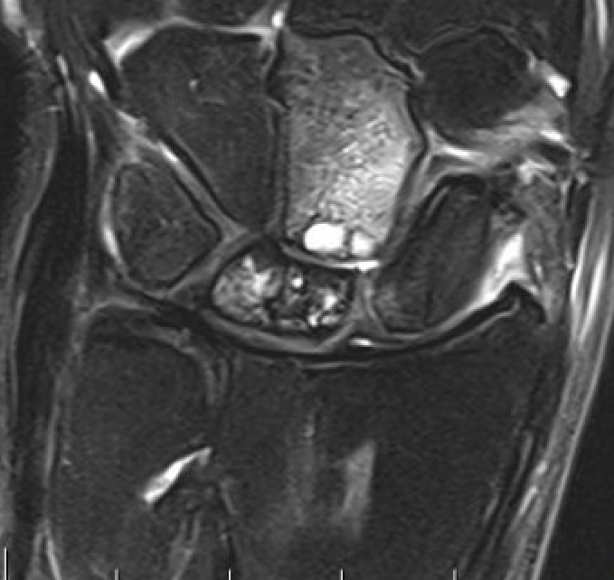 Kien MRI