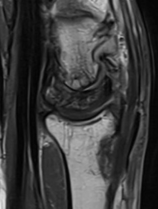 kien mri