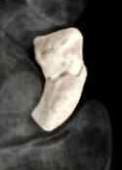 scaphoid