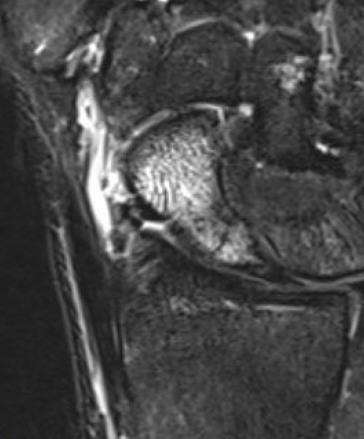 MRI