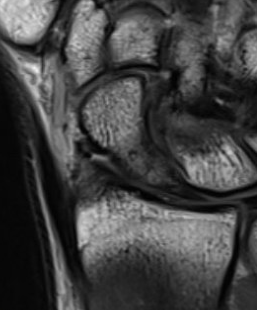 MRI